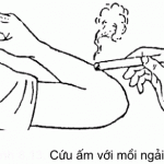 Phương pháp cứu điều trị đau
