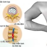 Đau trong bệnh lý thần kinh