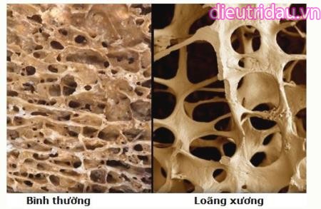 Bệnh loãng xương (Osteoporosis)