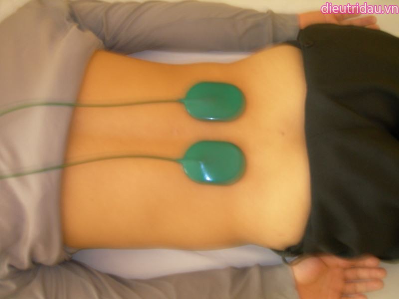 Hình 10. Điều trị bằng điện xung vào vùng thắt lưng. 