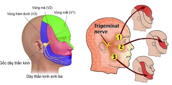 Zona thần kinh cấp tính ở nhánh mắt của dây thần kinh sinh ba