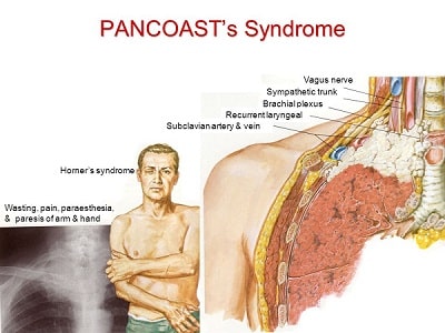 Hội chứng khối u Pancoast (U đỉnh phổi)