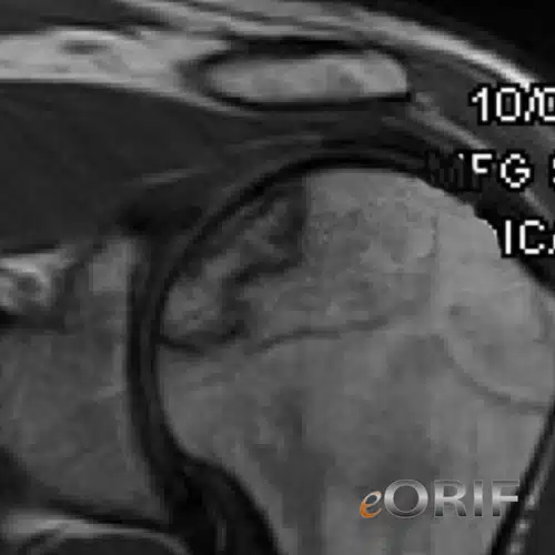 Dấu hiệu MRI hoại tử vô mạch khớp ổ chảo cánh tay