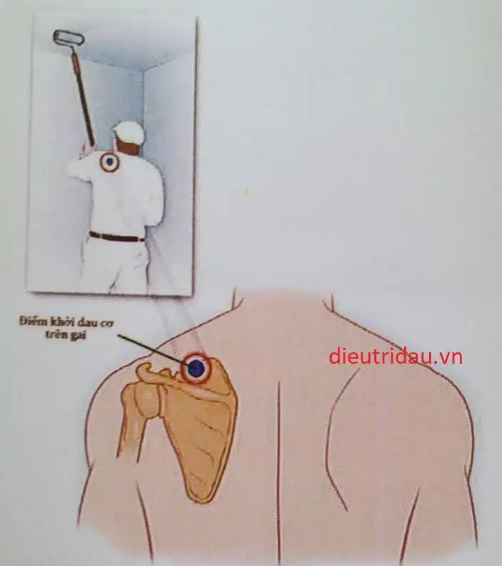 Ở những bệnh nhân có hội chứng gân cơ trên gai, điểm khởi phát (trigger point) nằm ở bờ trên xương bả vai
