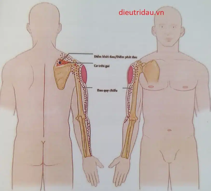 Đau khi vận động vai, và đau lan qua vai và chi trên không theo phân vùng cảm giác da là đặc trưng của hội chứng gân cơ trên gai
