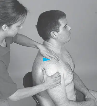 Trượt Khớp cùng vai - đòn ra Trước (PA)