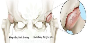 Phục hồi chức năng sau tiêm PRP vùng hông