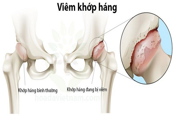 Phục hồi chức năng sau tiêm PRP vùng hông