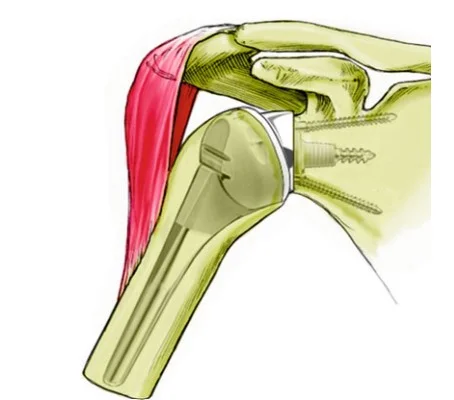 Inverse shoulder endoprostheses (Universp, Arthrex Inc.)